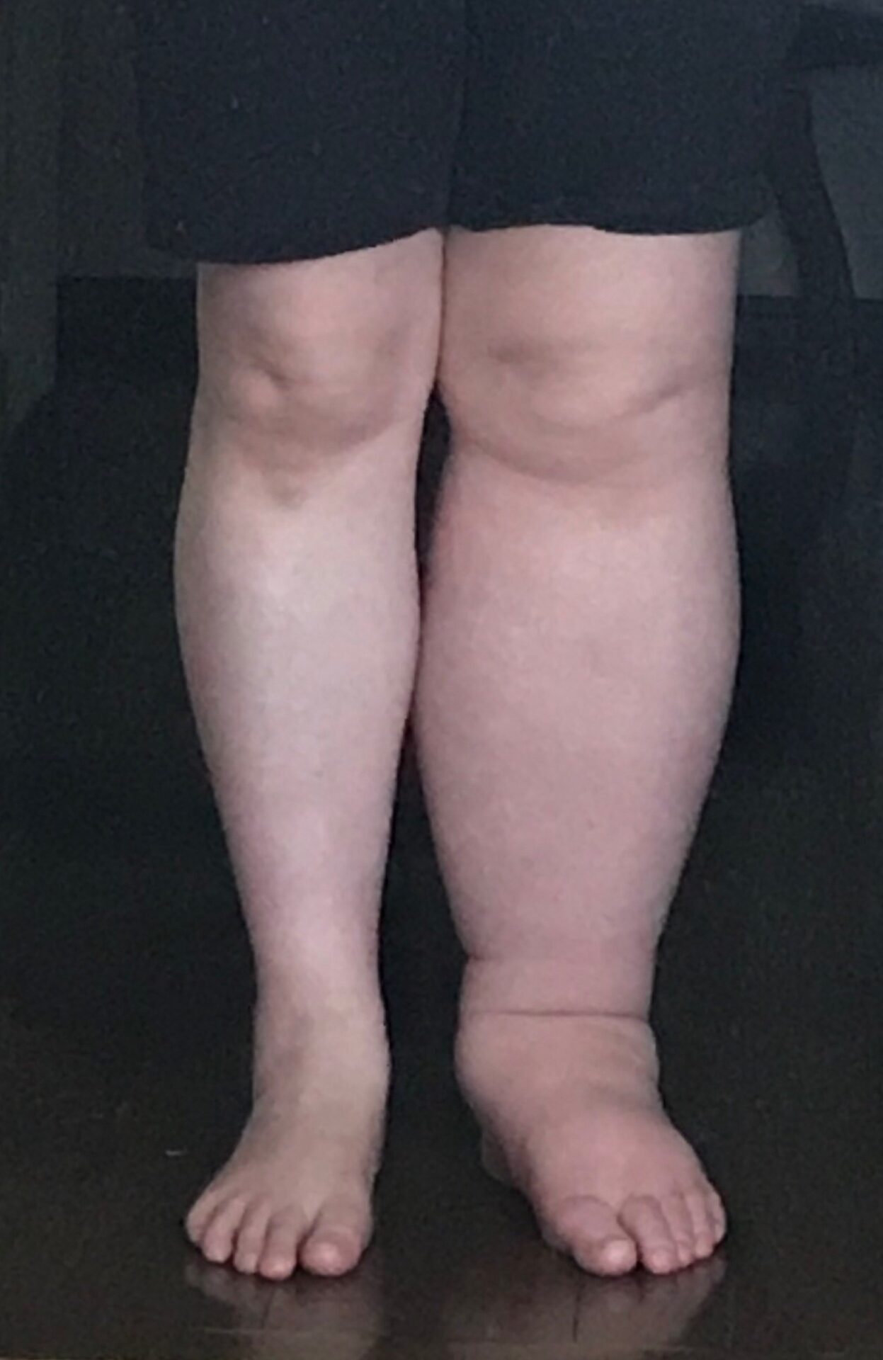 【体験談あり】下肢リンパ浮腫ケアとむくみ対策｜日常生活の工夫」